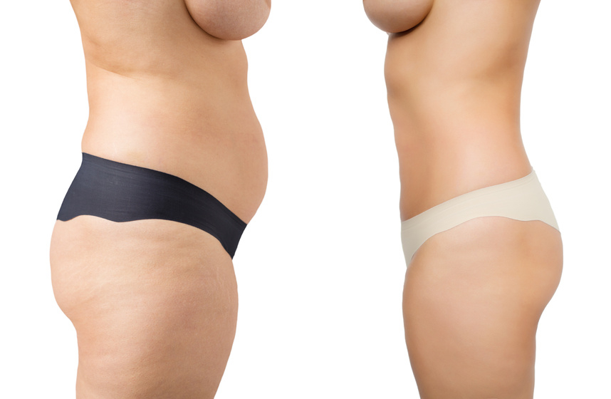 abdomen marcado con dieta